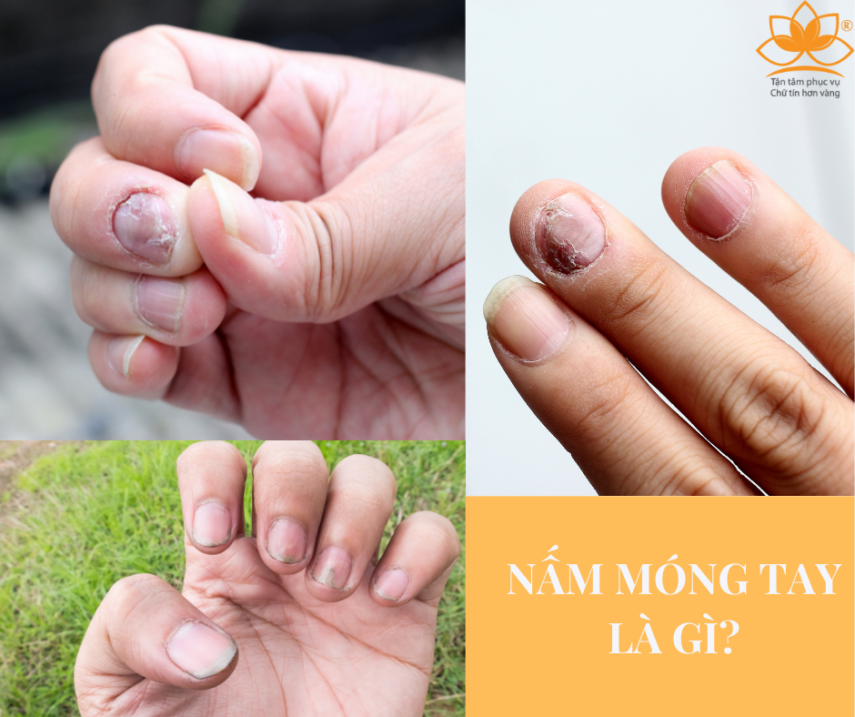 MỌI NGƯỜI ĐỀU CÓ THỂ TỪNG BỊ NẤM MÓNG TAY?